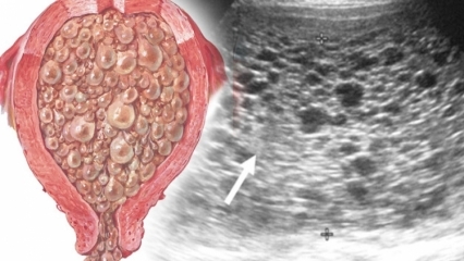 Qual è la gravidanza talpa (gravidanza dell'uva), quali sono i sintomi? Come capire la gravidanza talpa?
