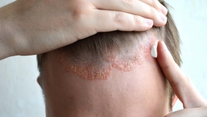 Quali sono i sintomi della dermatite seborroica e chi appare? Alimenti che scatenano la malattia