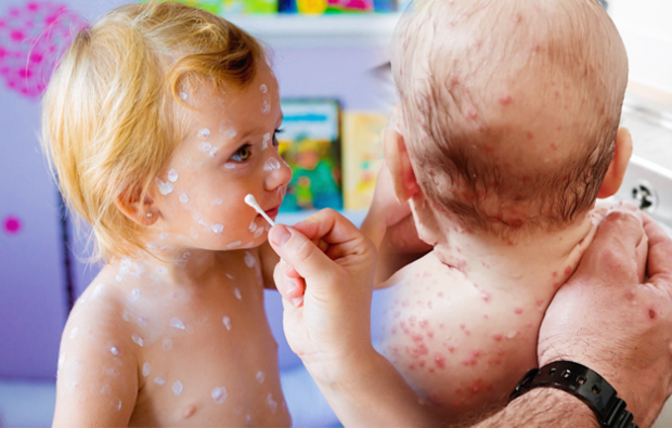 Sintomi della varicella nell'infanzia e nell'infanzia