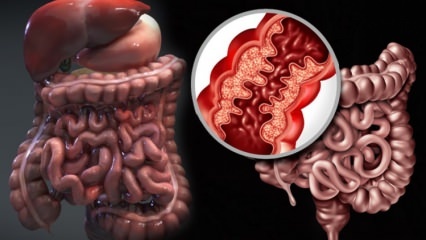 Qual è la malattia di Crohn? Quali sono i sintomi della malattia di Crohn? Esiste una cura per Crohn?