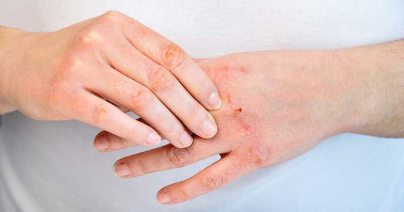 Che cos'è l'eczema? In che modo l'eczema è il più semplice? Colonia causa l'eczema della mano?