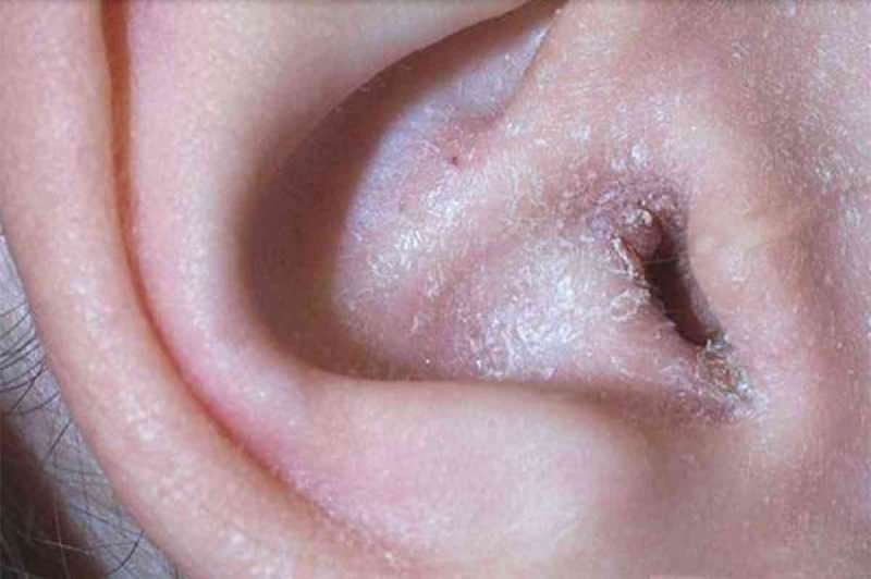 Cosa causa il peeling dietro l'orecchio e come passa? La soluzione definitiva per l'eczema dietro l'orecchio ...