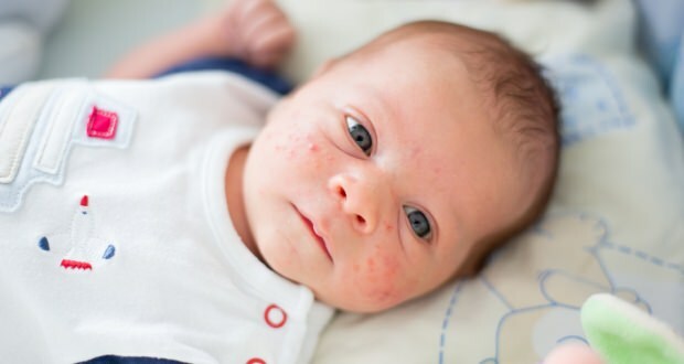 In che modo l'acne passa sul viso del bambino? Metodi di essiccazione dell'acne (Milia)