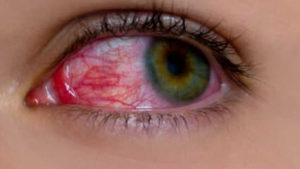 Quali sono le cause dell'allergia agli occhi? Quali sono i sintomi dell'allergia agli occhi? Cosa fa bene alle allergie agli occhi? 