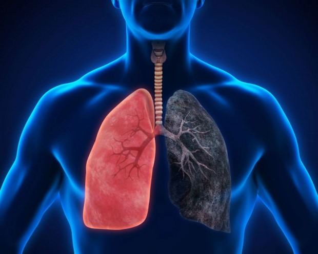 cos'è il cancro ai polmoni