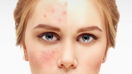 Creme in farmacia che hanno l'acne più efficace 2020