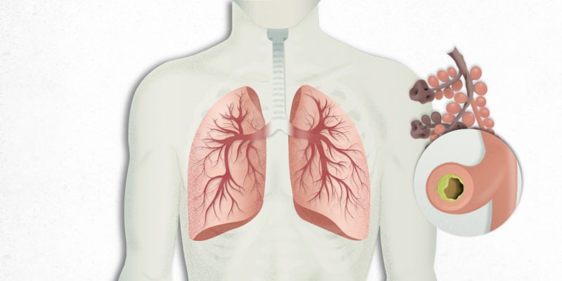 il virus che si deposita nei polmoni si mescola con la polmonite