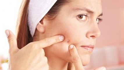Quali sono le acne che non dovrebbero annoiarsi?