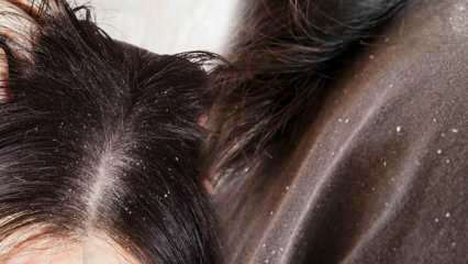Come passa la forfora e cosa fa bene ai capelli con forfora? 5 metodi più veloci ed efficaci per la rimozione della forfora