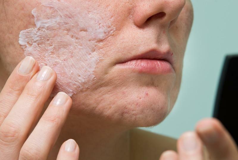 Quali sono le cause dell'acne infiammata e come va via? Maschera che asciuga l'acne infiammata