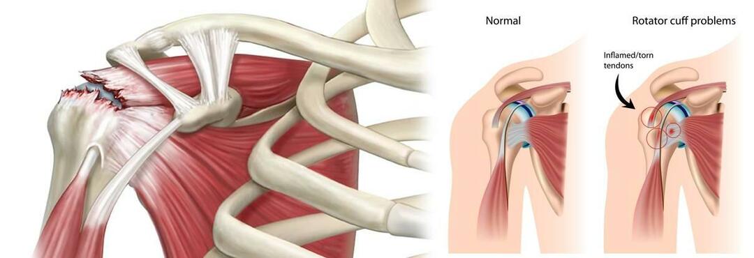 Perché si verifica uno strappo alla spalla? Come viene trattata una rottura della spalla?