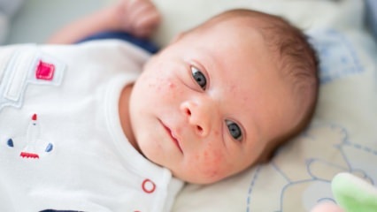 In che modo l'acne passa sul viso del bambino? Metodi di essiccazione dell'acne (Milia)
