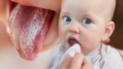 Sintomi e trattamento del mughetto nei neonati! Come viene trasmesso il mughetto nei neonati? La soluzione esatta ...