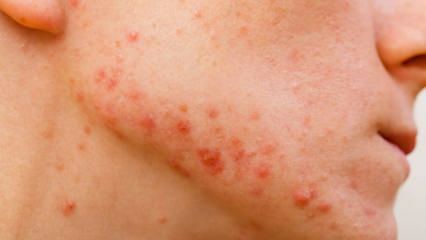 Come passa l'acne cistica? Cosa fa bene all'acne cistica?
