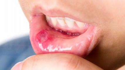 Ulcera in bocca!