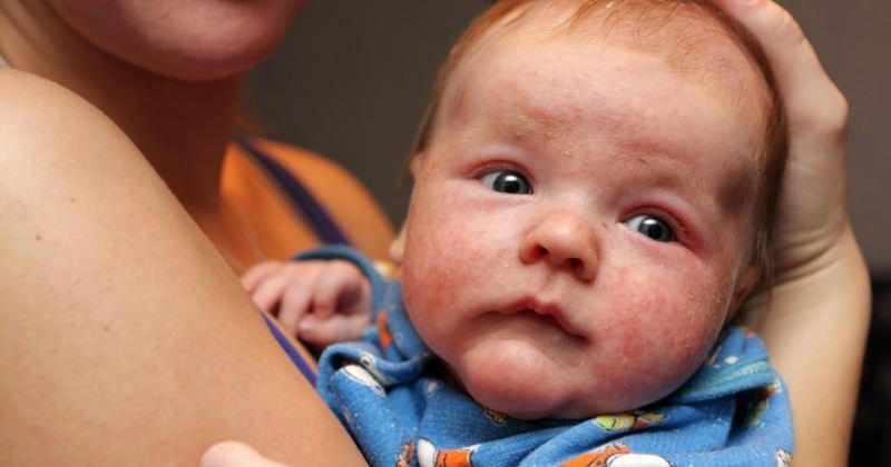 Cause di arrossamento degli occhi nei neonati