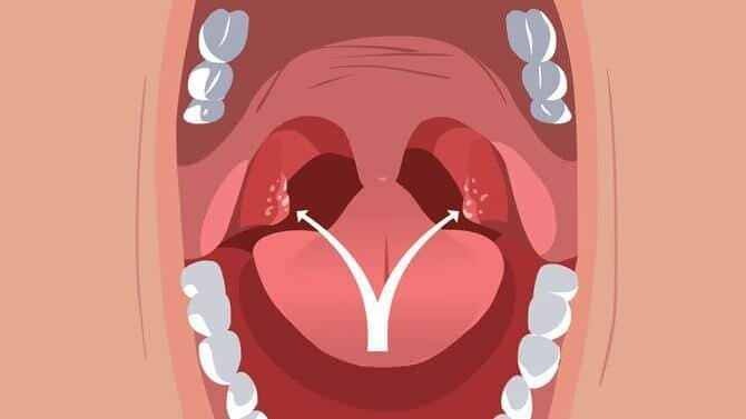 Provoca macchie infiammate sulla superficie delle tonsille