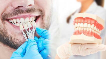 Perché le faccette in zirconio vengono applicate ai denti? Quanto dura il rivestimento in zirconio?
