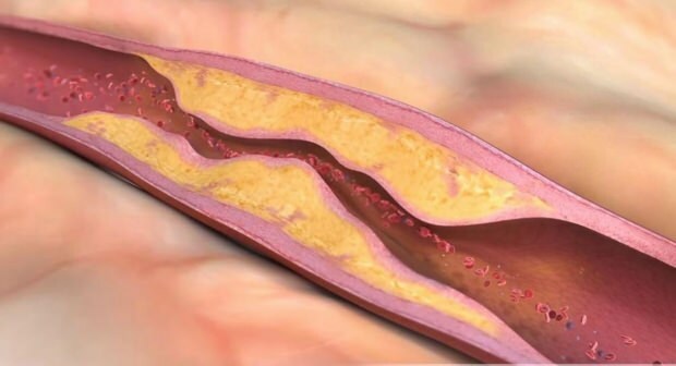 Che cosa causa l'aterosclerosi? Quanti tipi di occlusione vascolare esistono?