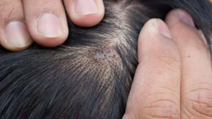 Perché l'acne appare sul cuoio capelluto? Come passano i brufoli sul cuoio capelluto?