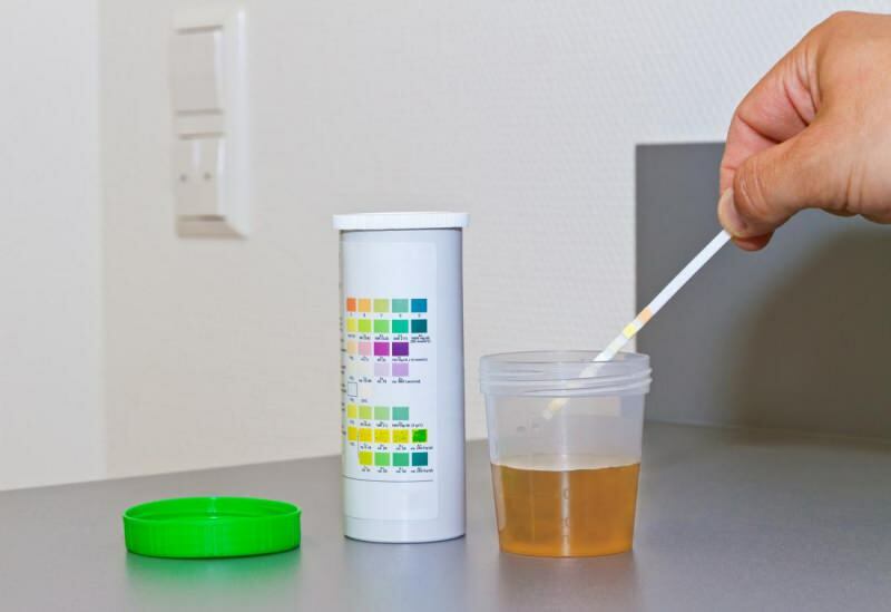 il livello di bilirubina si verifica di solito nel test delle urine