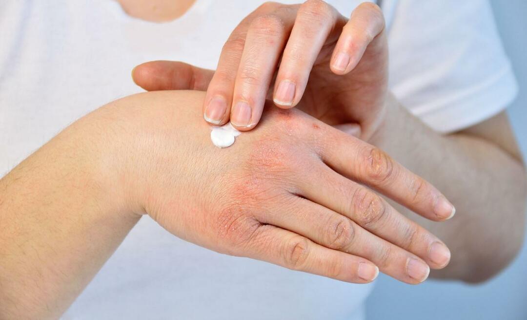 Cos'è l'eczema da stress e quali sono i suoi sintomi? Come viene trattato l'eczema correlato allo stress?