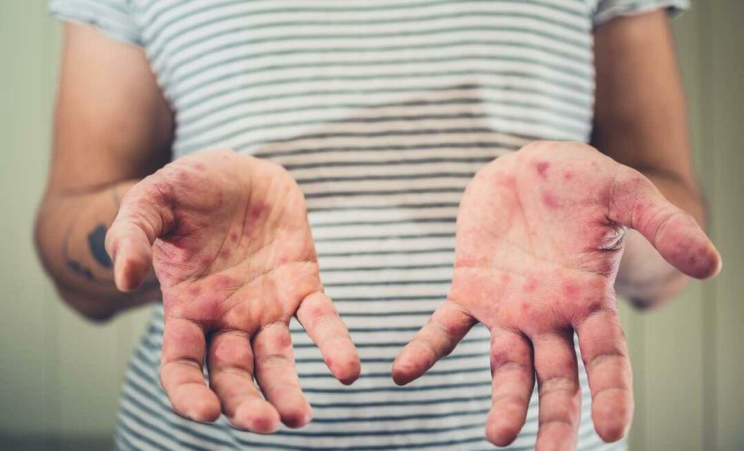 Qual è la malattia del figlio di Burcu Kara? Quali sono i sintomi della malattia della mano, dell'afta epizootica? 