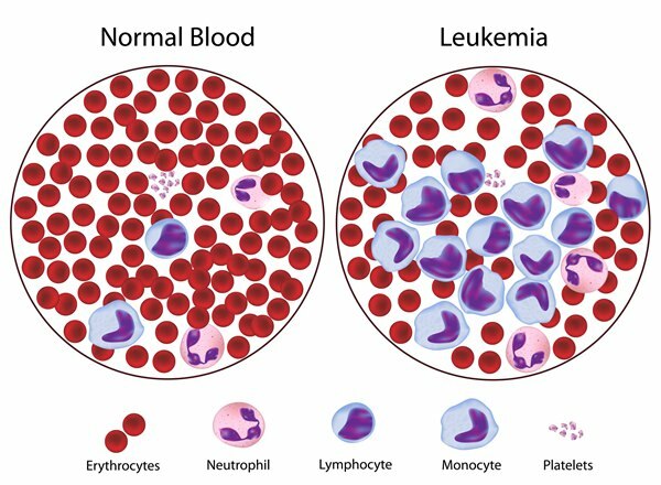 che cos'è la leucemia