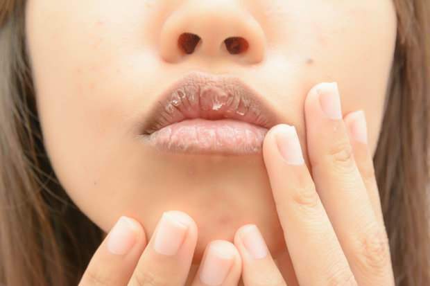 l'anemia provoca labbra secche