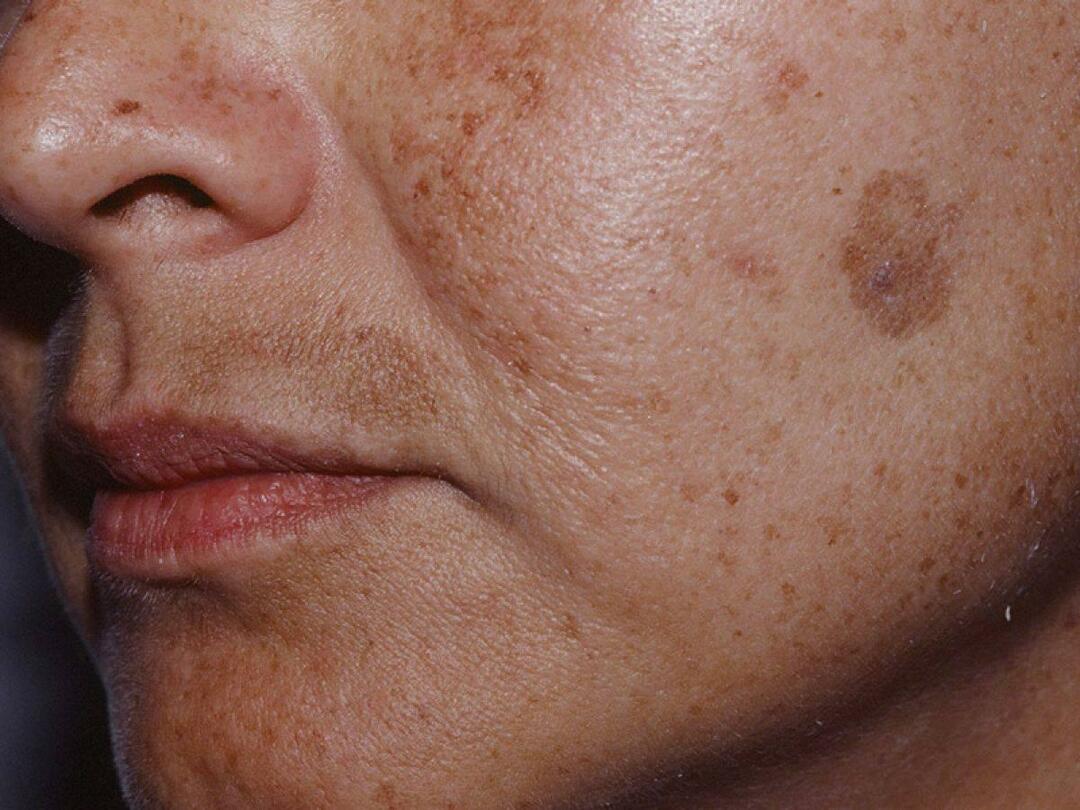 Cos'è il protocollo di colorazione e come si esegue? Il Blemish Protocol danneggia la pelle?