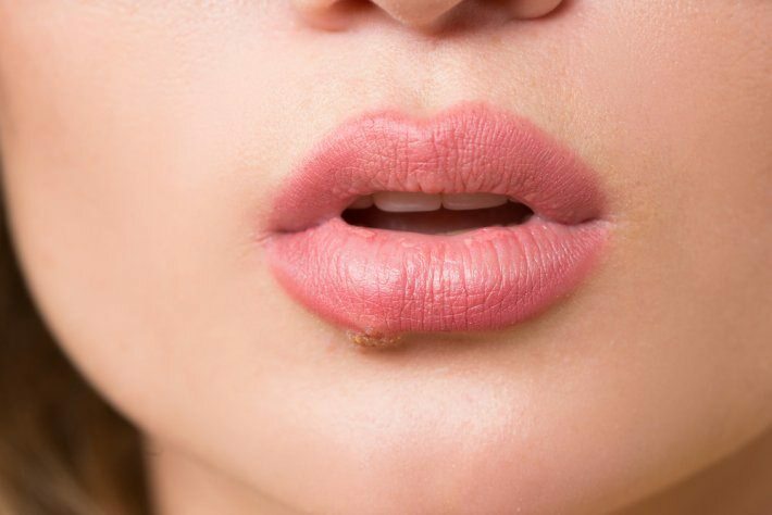 Cos'è il cancro alla lingua? Quali sono i sintomi?