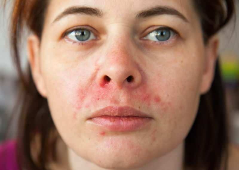 Perché l'acne appare intorno al labbro? Come viene trattata la dermatite periorale?