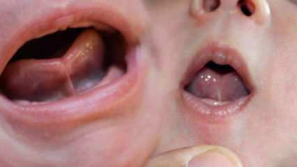 Qual è il legame lingua (Ankyloglossi) nei neonati? Sintomi e trattamento del legame con la lingua ...