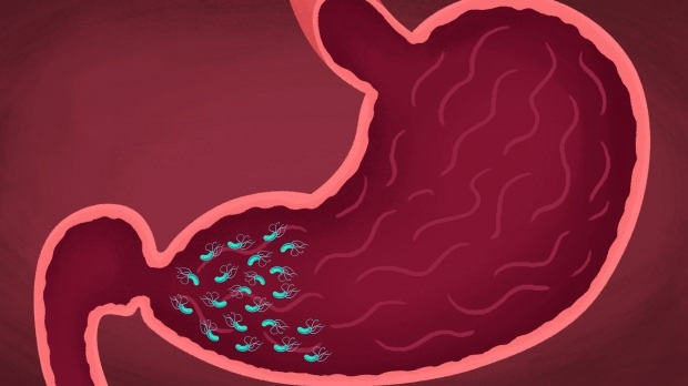 alcuni virus e batteri possono causare gastrite