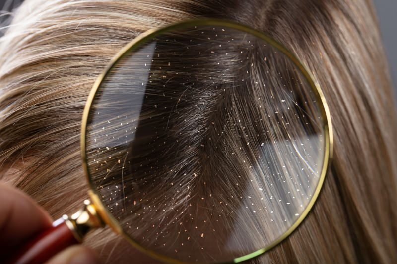 Come passa la forfora e cosa è buono per i capelli con forfora? I 5 rimedi antiforfora più veloci ed efficaci