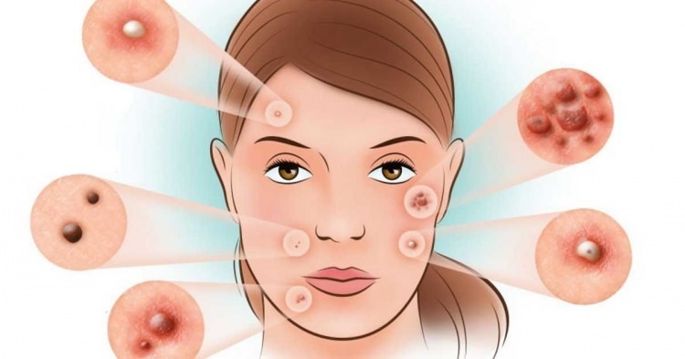 Come vengono trattati l'acne?