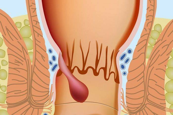 Come si verificano le emorroidi nella parte anale 