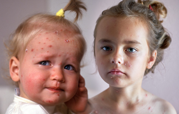 Trattamento della malattia della varicella