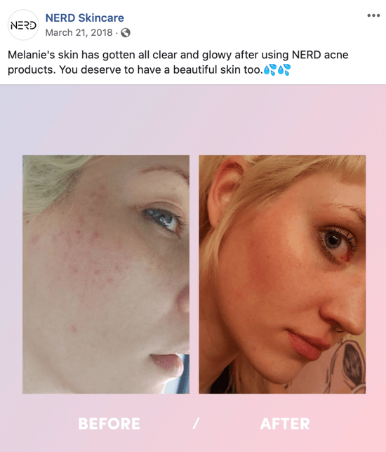 Esempio di come Nerd Skincare ha utilizzato un'immagine prima e dopo per creare un'immagine post per i social media che guida gli acquisti dei propri prodotti.