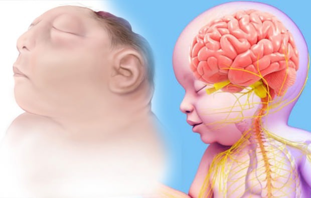 Il bambino Anencefalia vive? Diagnosi di anencefalia