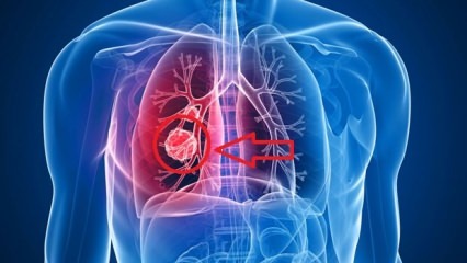 Sintomi del carcinoma polmonare: stadi del carcinoma polmonare!
