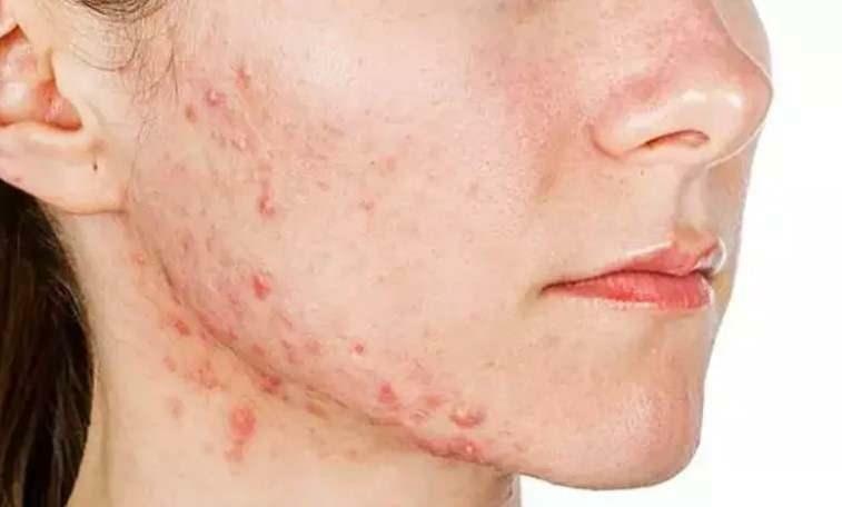 preghiera contro l'acne