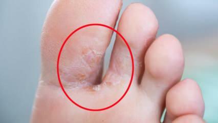 Cos'è il fungo del piede? Quali sono i sintomi del piede d'atleta? Trattamento del piede d'atleta 