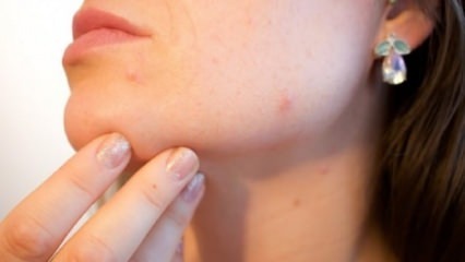 Rimedio naturale per l'acne sul mento