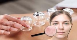 Quali sono i benefici della coppettazione per pelle e capelli? La coppettazione cura l'acne?