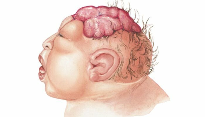 Che cos'è l'anencefalia? Quali sono i sintomi dell'anencefalia nei neonati e nei bambini? L'anencefalia provoca ...