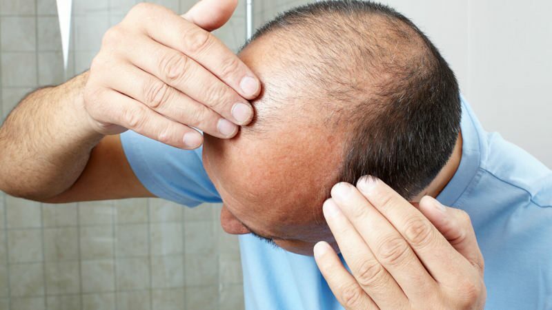 Il trapianto di capelli previene il ghusl?