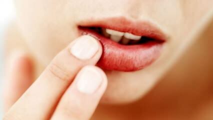 Cosa è buono per le labbra screpolate?