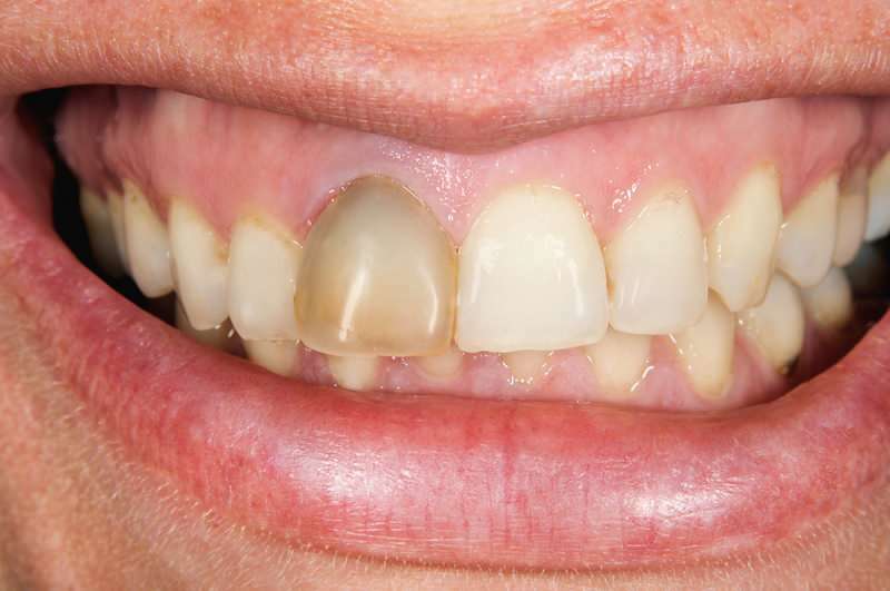 l'oscuramento dei denti a volte può concentrarsi su un dente
