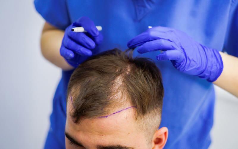 È consentito il trapianto di capelli nel trattamento della caduta dei capelli? Cosa sono i capelli protesici? I capelli protesici ostacolano il ghusl?